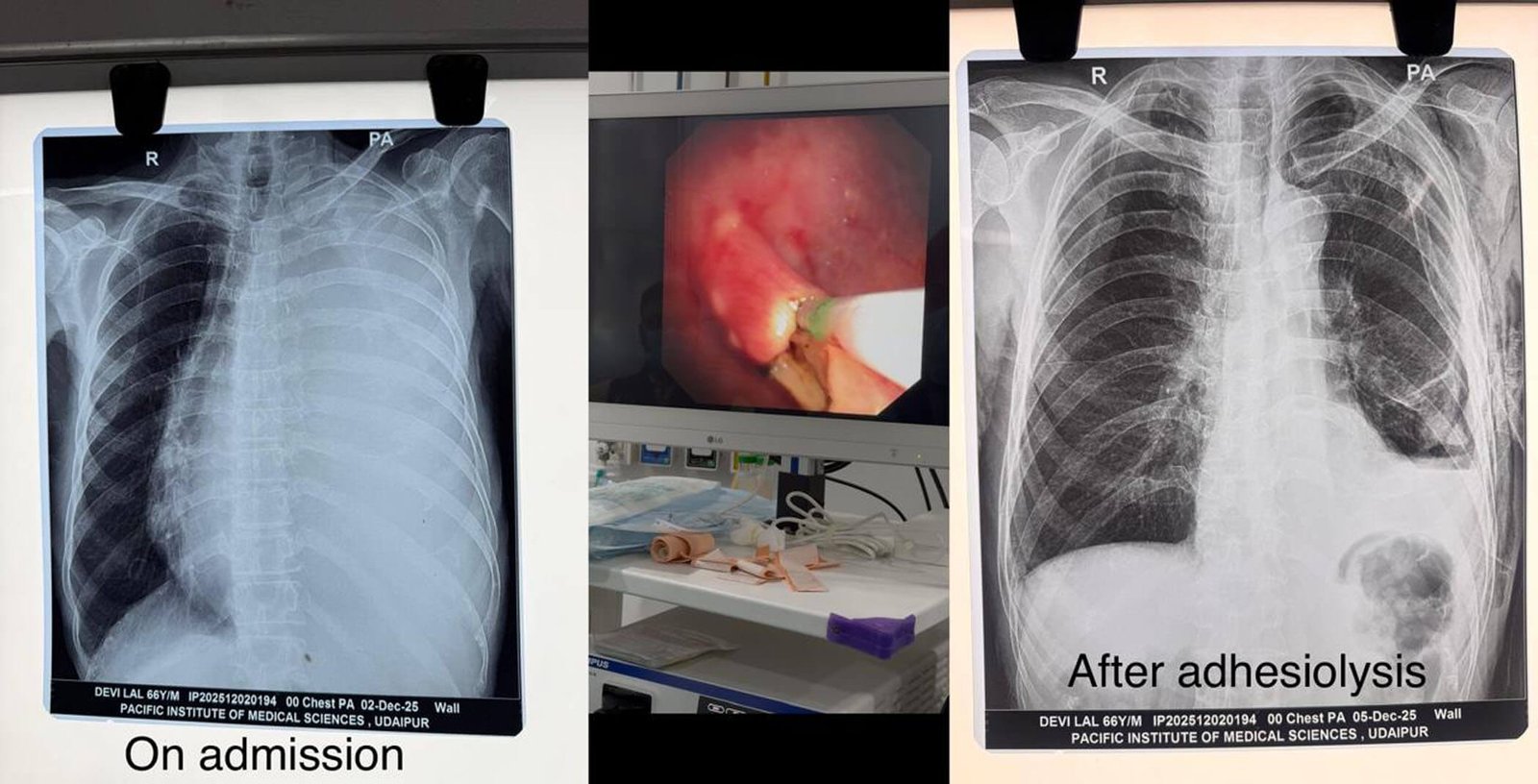 पिम्स हॉस्पिटल में 66 वर्षीय रोगी का सफलतापूर्वक उपचार
