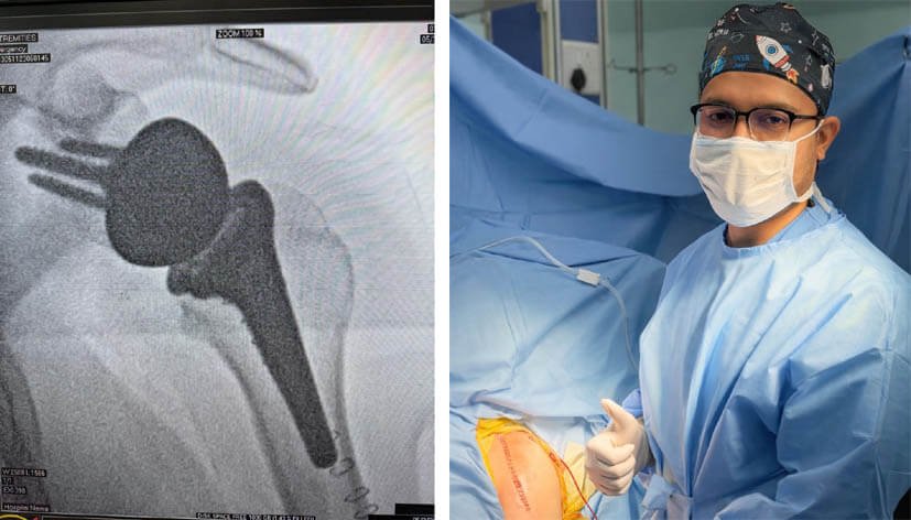 पिम्स हॉस्पिटल उमरड़ा के ऑर्थोपेडिक विभाग द्वारा रिवर्स सोल्डर रिप्लेसमेंट की सफल सर्जरी